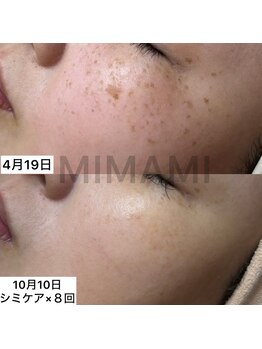 ミナミ(MINAMI)/シミにしっかりアプローチ