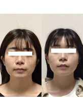 アレイズ/小顔矯正コース（10回）