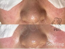 シードリン(Seedling)/毛穴エクストラクション