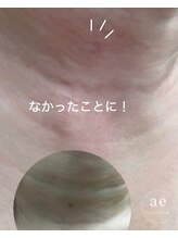 アエ(ae)/スポットクリア