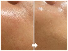 サロン ド ジョワ(salon de joie)/40代毛穴引締めツルツル肌