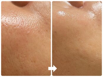 サロン ド ジョワ(salon de joie)/40代毛穴引締めツルツル肌