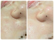 トータルビューティ ノイド(Noid)/毛穴洗浄　全顔