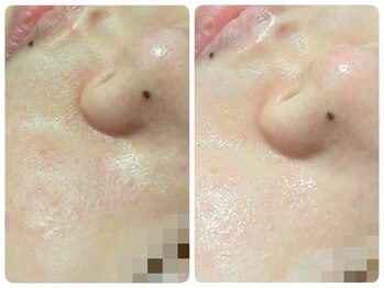 トータルビューティ ノイド(Noid)/毛穴洗浄 全顔