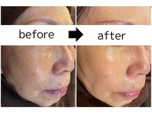 シミケア専門店　肌管理ラボ　RaPur/ハーブピーリング