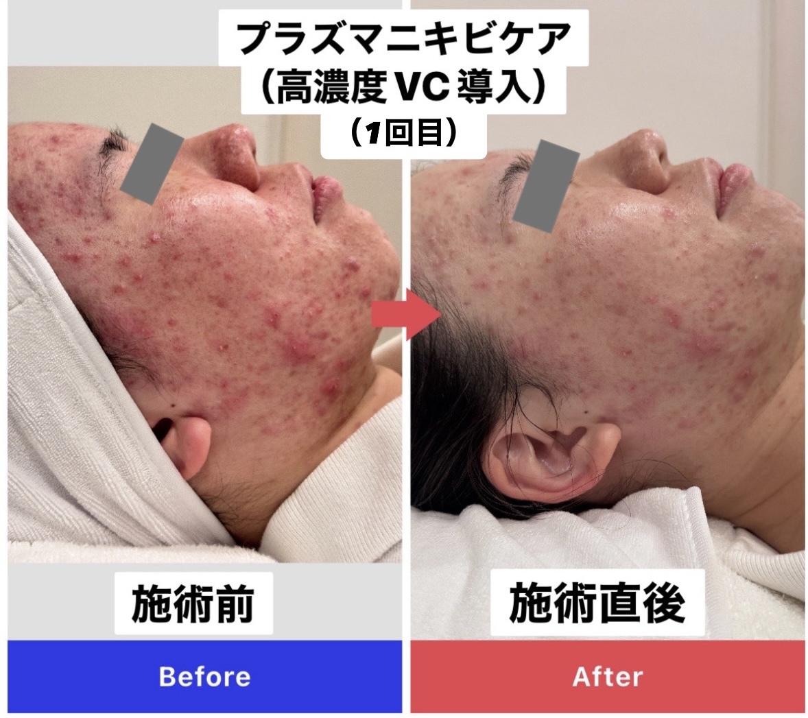 エトワール(etoile)/☆ニキビ・肌荒れ改善☆