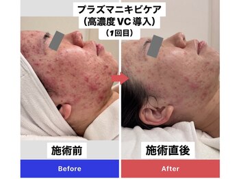 エトワール(etoile)/☆ニキビ・肌荒れ改善☆