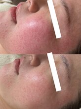 モンレーヴ(mon reve)/レストセルトリートメント