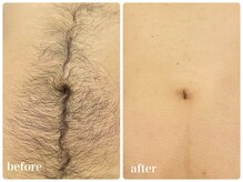 エリクサー 加須店(Elixir)/毛がないだけで肌トーンアップ！