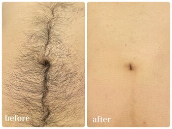 エリクサー 加須店(Elixir)/毛がないだけで肌トーンアップ!