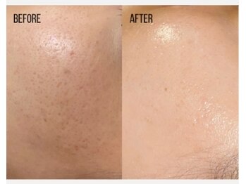 サロンド エステ ミニョン(salon de esthe mignon)/ラミネーションピール