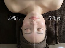 ラースパ アザブ(La SPA azabu)/小顔before→after