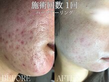 リアン 南熊本店(Lien)の雰囲気（1回でこの変化！毛穴レス×小顔［毛穴痩身/小顔］）