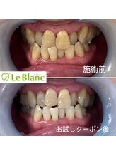 ルブラン 奈良店(Le Blanc)/もう歯が黄色いとは言わせない！