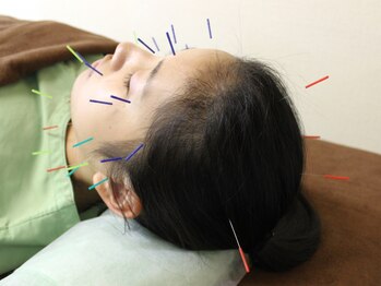 いなほ はりきゅう整骨院 東新宿/鍼灸(吸い玉併用)コース
