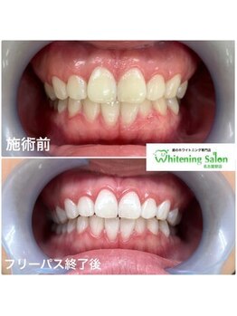ホワイトニングサロン 名古屋駅店/【ホワイトニング施術例】