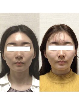 アレイズ/小顔矯正コース(10回)