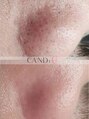 キャンディー 梅田茶屋町(CANDi)&nbsp;ピーリング 毛穴相性