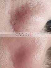 キャンディー 梅田茶屋町(CANDi) ピーリング 毛穴相性