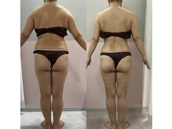 ローズハニー 小田原店/痩身モニター様比較写真