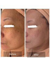 エメ(Aimer)/【40代レモンダーマ結果☆】