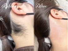 ピミル(PIMIL)/うなじ脱毛/赤坂