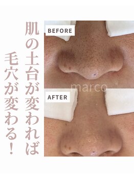 マルコ(marco)/毛穴・肌質改善
