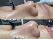 ナチュールムーン(Nature moon.)/毛穴洗浄