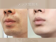 ミシェリ(MCHERI)/ヒゲ脱毛