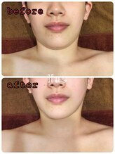 イルス(Ilus)/オールバンドでスッキリ！