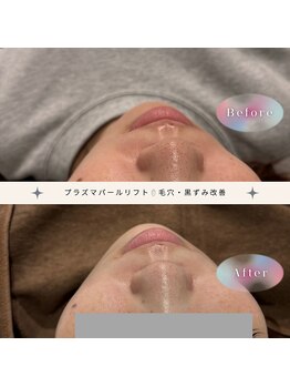 ディアー(Dear)/プラズマパールリフト