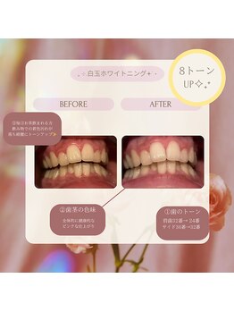 プラスビーセルフ(+b self)/ホワイトニングビフォーアフター