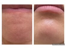 アルマ(ALMA)/スキンケアを変えるだけで変わる