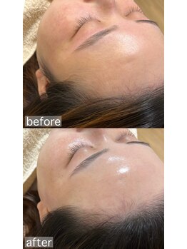 アルム(a'lm)/フェイスワックス/顔脱毛