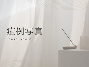 シーベル 代官山/症例写真/ハーブピーリング