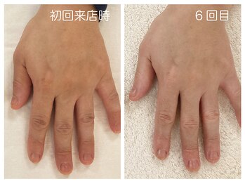 キレイテ 福岡天神店/50代/6回目【福岡ハンドケア】