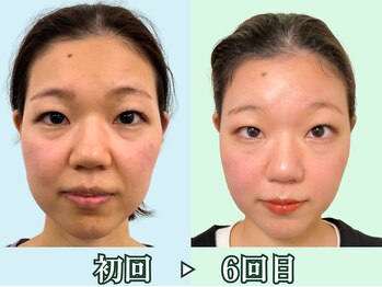 ナチュラルパーフェクトフェイス 新宿/２０代、タルミ左右差/新宿造顔