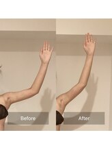 アラマンダ(Allamanda)/二の腕BeforeAfter