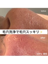チーズ(CHI’S)/毛穴汚れのお悩み一番は『鼻』