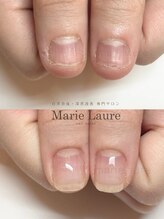 マリーロール 梅田店(Marie Laure)/深爪矯正/自爪育成/自爪風