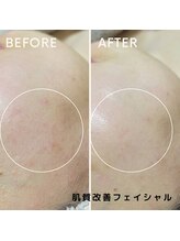 フェイエール鍼灸院 ラスィーヌ(fier鍼灸院 racine)/肌質改善フェイシャル