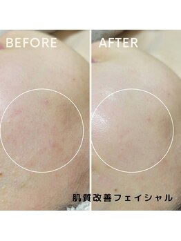 フェイエール鍼灸院 ラスィーヌ(fier鍼灸院 racine)/肌質改善フェイシャル