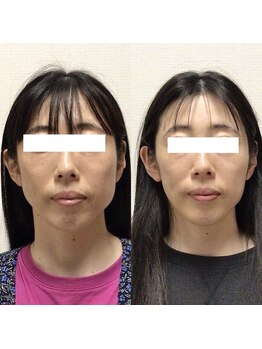 アレイズ/小顔矯正コース(10回)