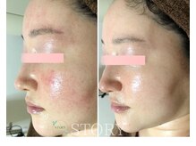 ストーリー(STORY)/ハーブピーリング専門店STORY