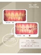 スリール(sourire)/ビフォーアフター