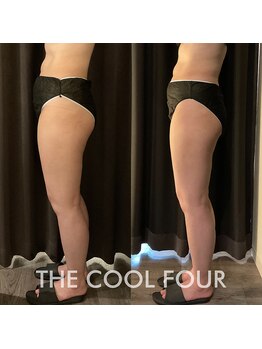 クライオ360(Cryo360)/脂肪冷却ビフォーアフター