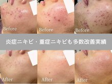 ニキビ研究所 千葉店