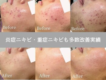 ニキビ研究所 千葉店