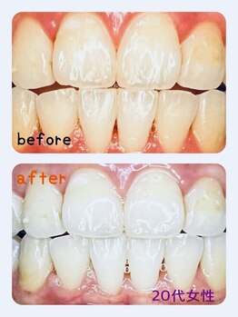 ピュールホワイト(Pur white)/歯のホワイトニング