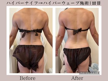 ワイズビューティー(Y's Beauty)/【本気痩せコース】